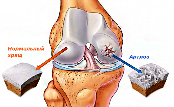 artritis koljena jaka bol tablete bol u zglobovima učiniti
