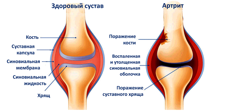 artroza način liječenja sezonsko liječenje artritisa artritisa