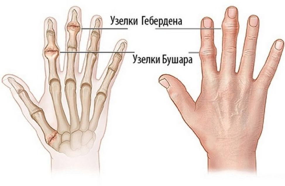 узелки гебердена на пальцах рук